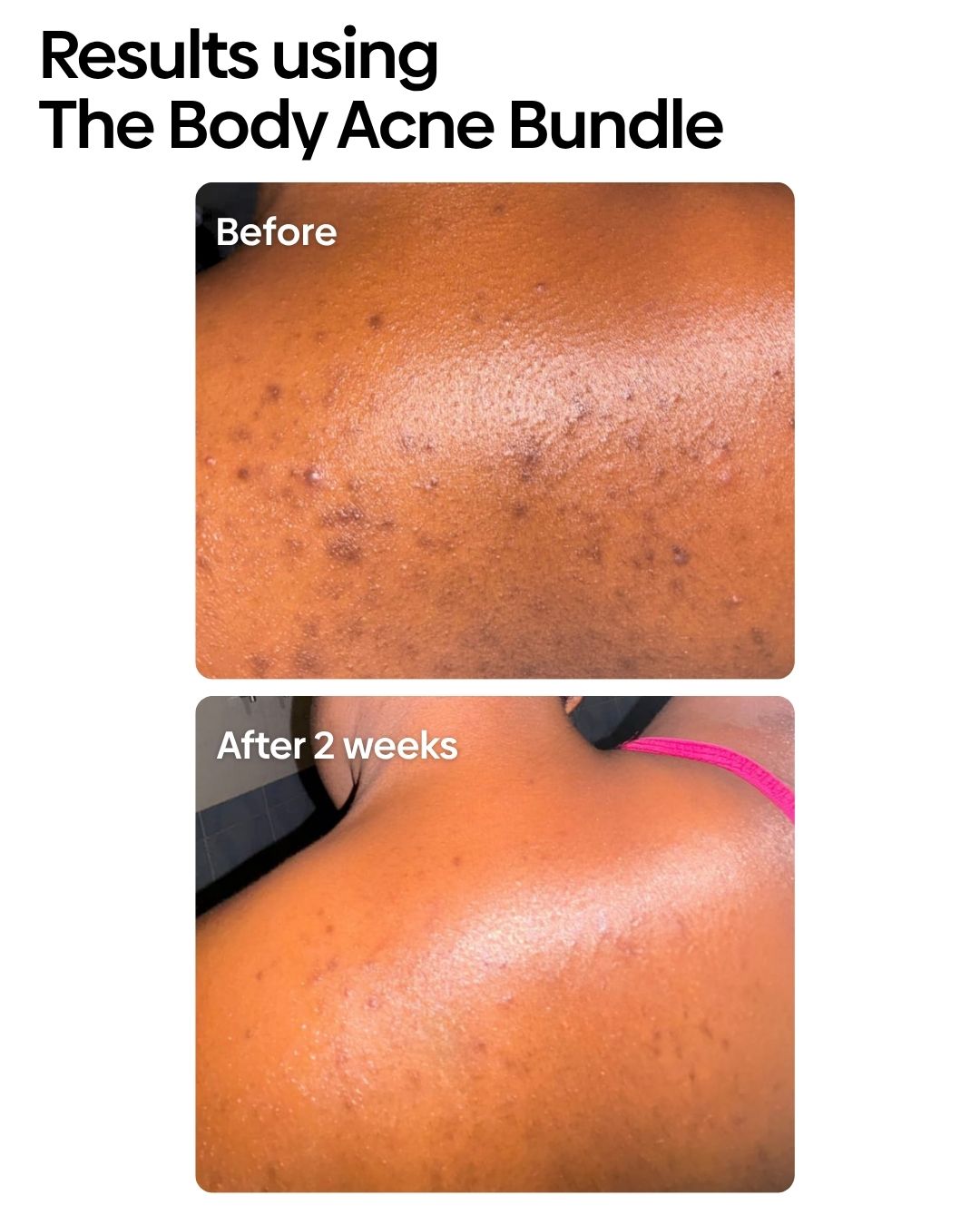 Anti Body Acne Bundle