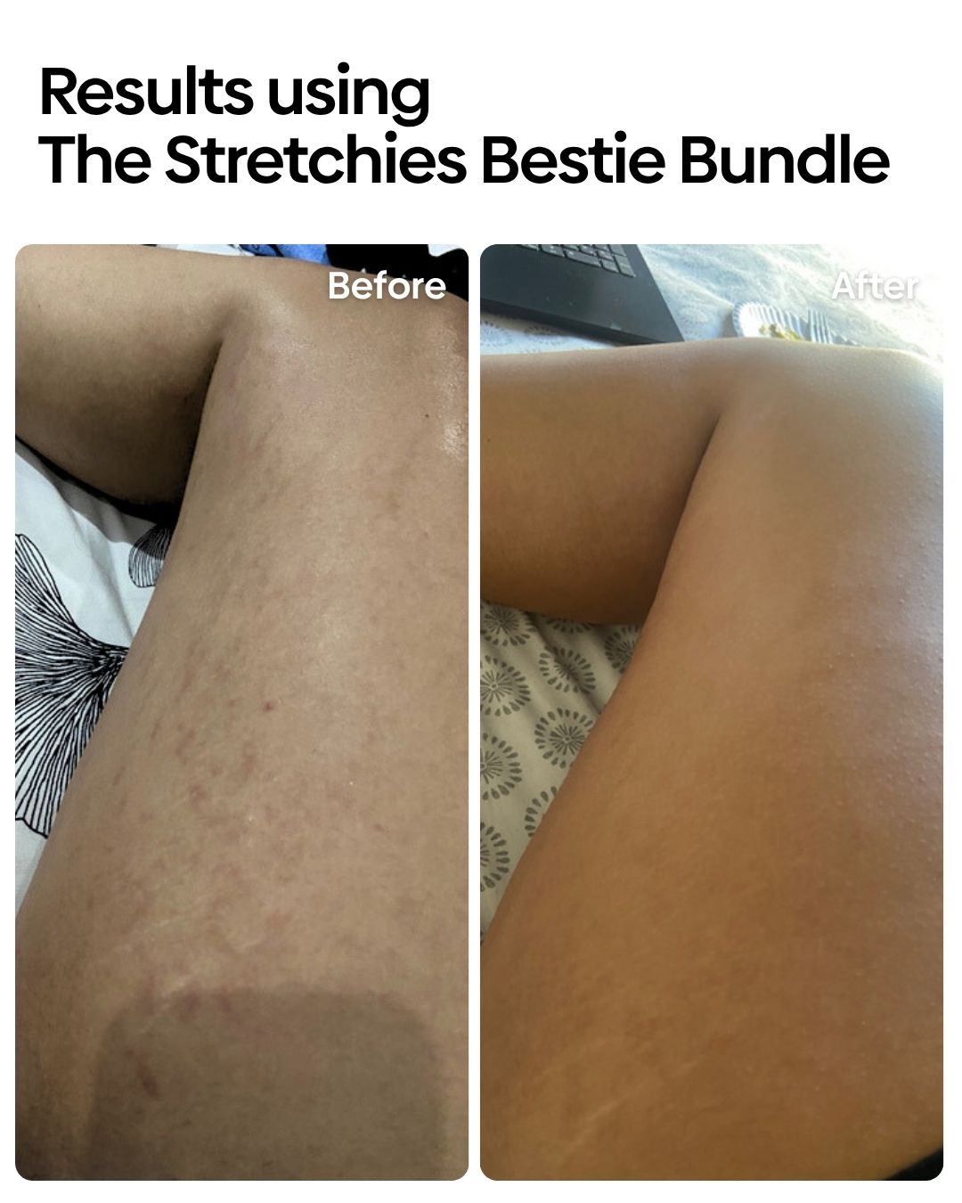 Stretchies Bestie Bundle