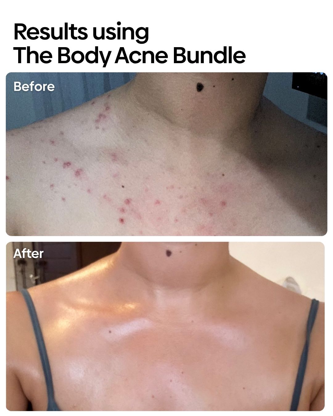 Anti Body Acne Bundle