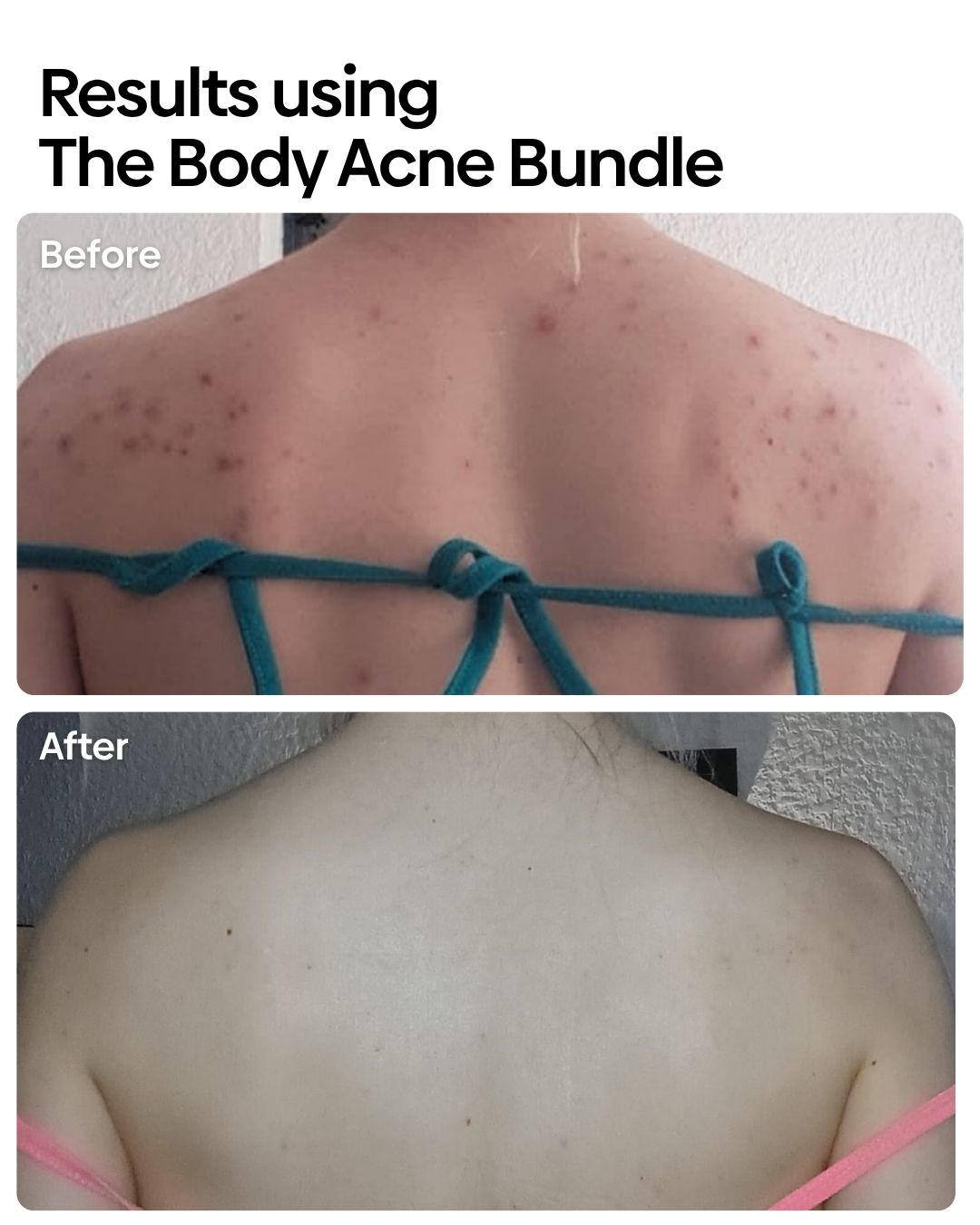 Anti Body Acne Bundle